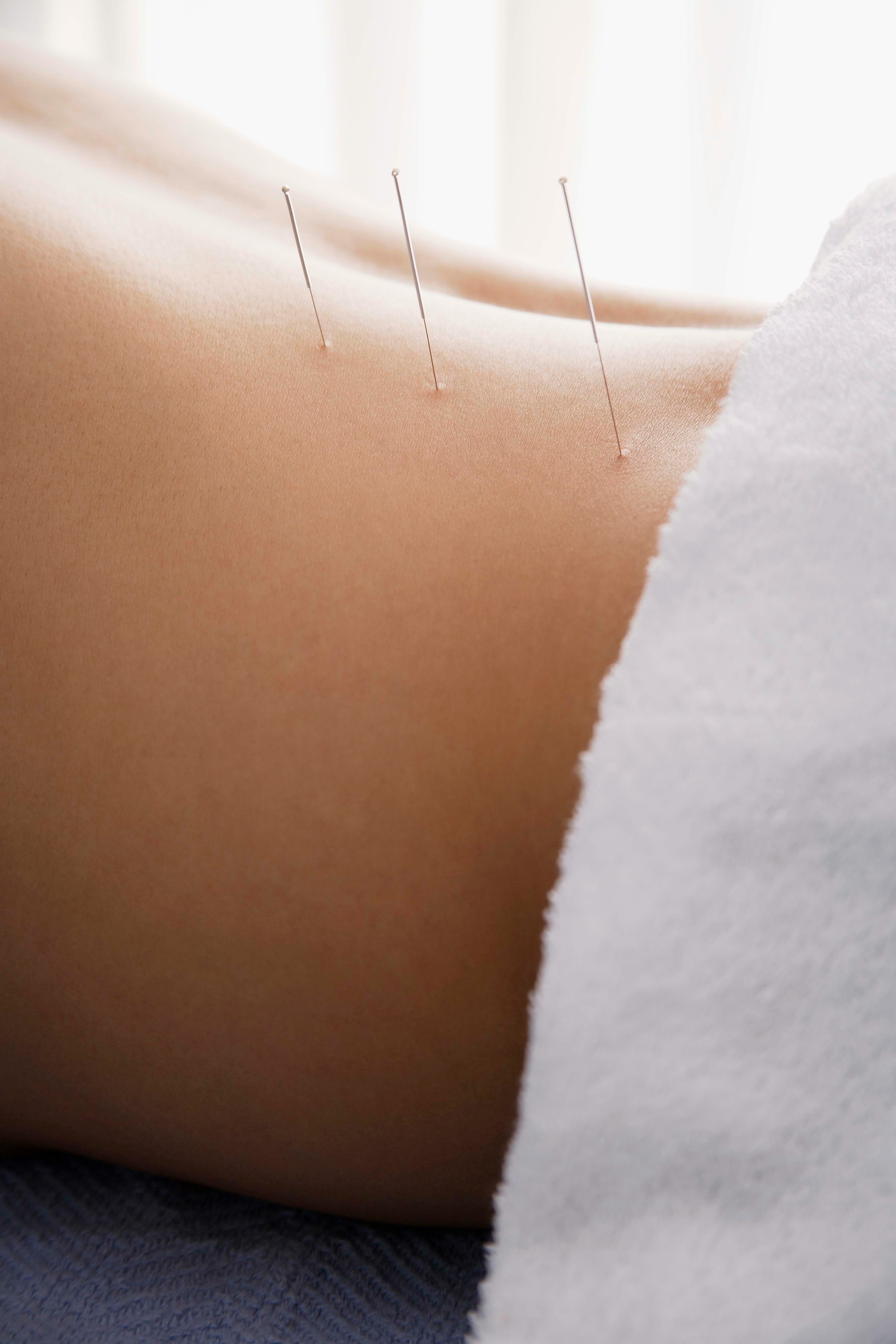 Acupuncture treatment