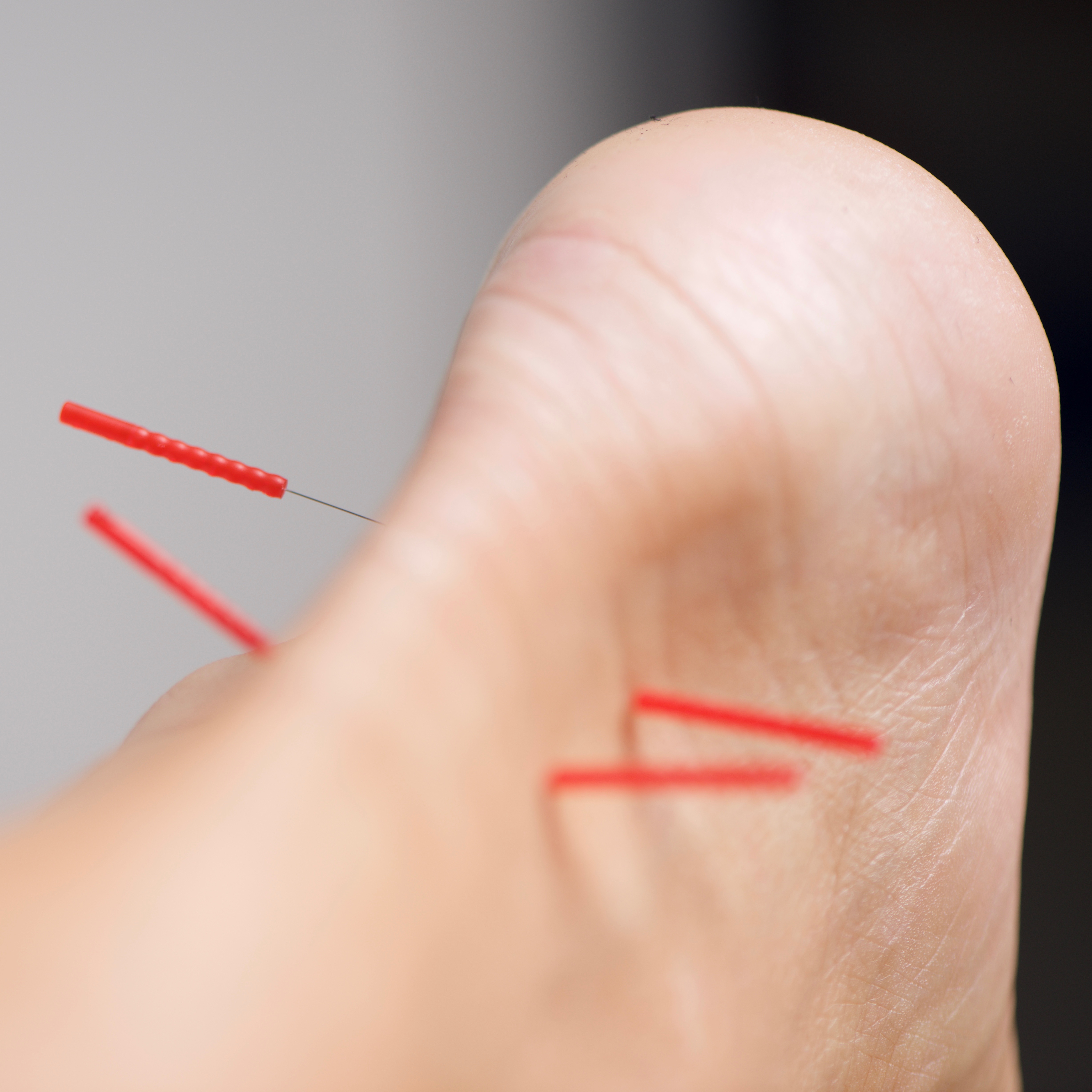 Close-up of dry needling treatment on a foot at The Verbier Touch